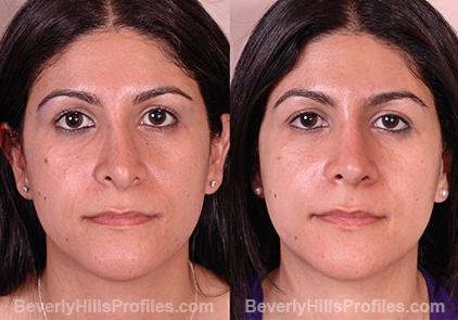 Revision Rhinoplasty Before and After Photo Gallery - front view, female patient 15