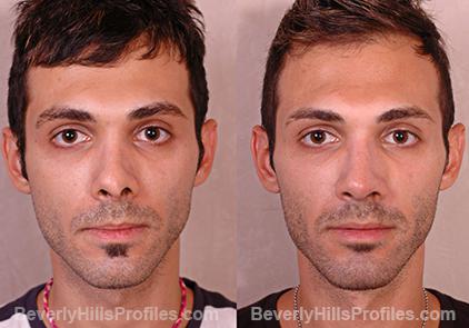 Revision Rhinoplasty Before and After Photo Gallery - front view, male patient 3