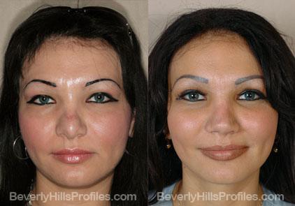Revision Rhinoplasty Before and After Photo Gallery - front view, female patient 6