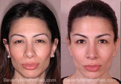 Revision Rhinoplasty Before and After Photo Gallery - front view, female patient 14