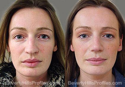 Revision Rhinoplasty Before and After Photo Gallery - front view, female patient 18