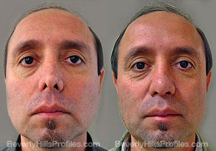 Revision Rhinoplasty Before and After Photo Gallery - front view, male patient 25