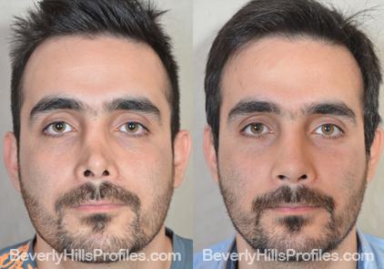 Revision Rhinoplasty Before and After Photo Gallery - front view, male patient 2