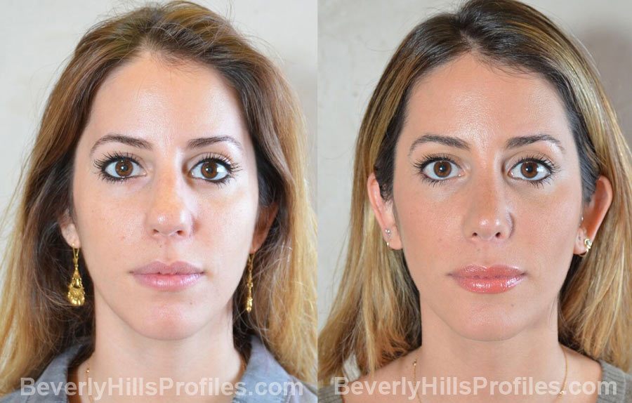 imgs Female patient before and after Nose Surgery, front view