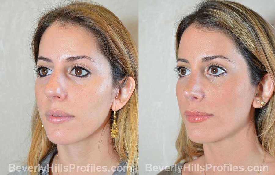 imgs Female patient before and after Nose Surgery, oblique view