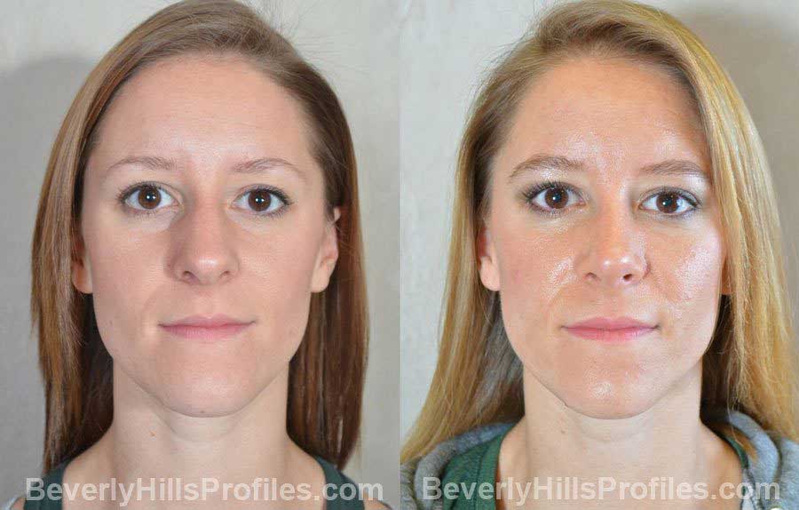 pics Female patient before and after Nose Surgery - front view