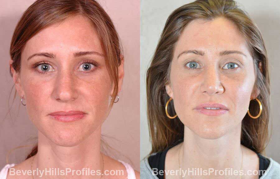 imgs Female patient before and after Nose Surgery - front view