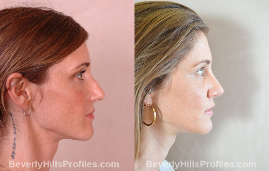 imgs Female patient before and after Nose Surgery - right side view