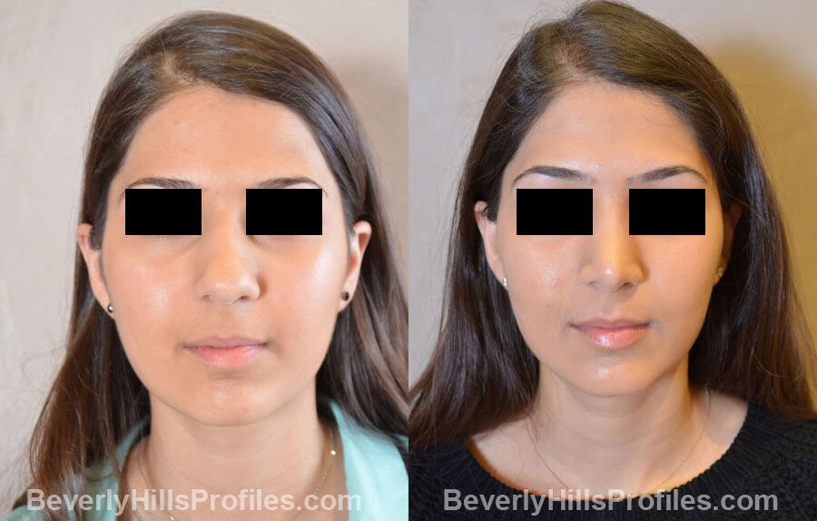 images Female patient before and after Nose Surgery - front view