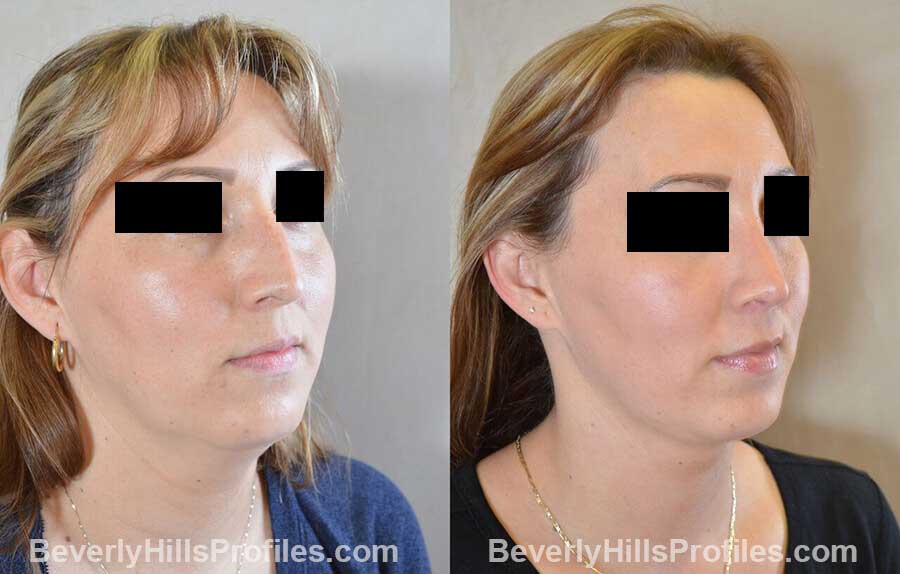 photos Female patient before and after Nose Surgery - front view