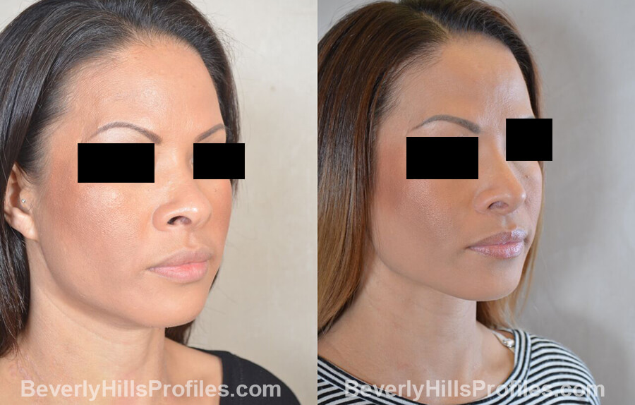 pics Female patient before and after Nose Surgery, oblique view