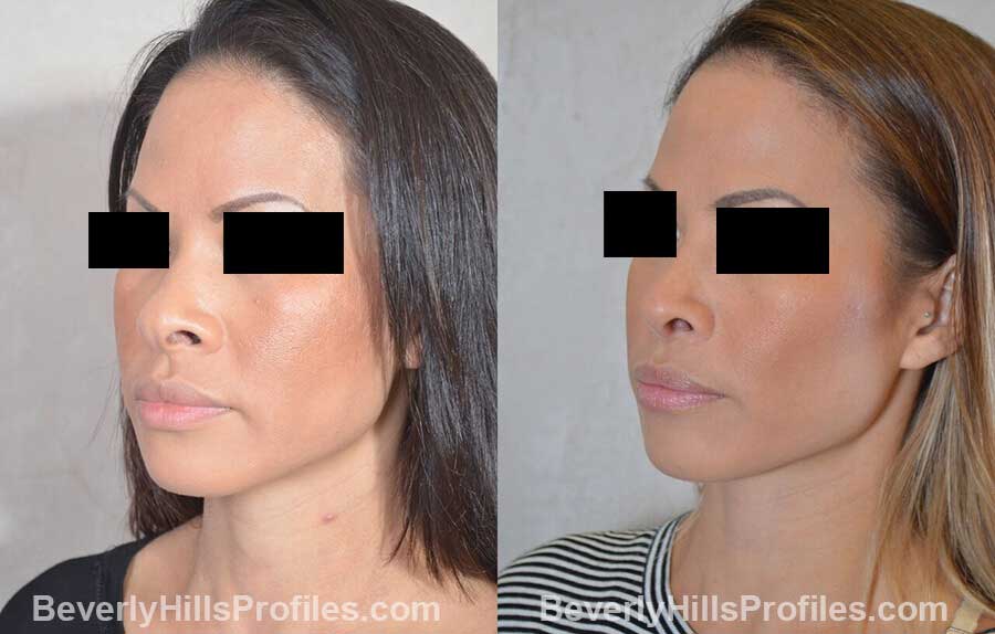 pics Female patient before and after Nose Surgery, left oblique view