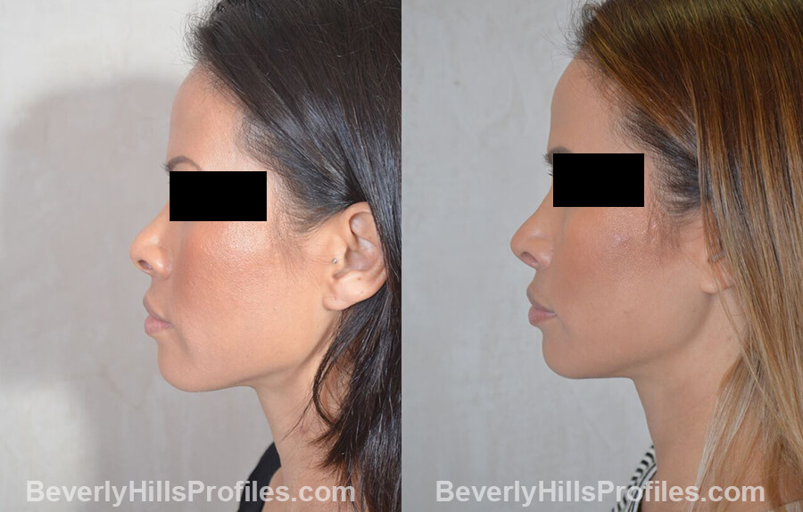 pics Female patient before and after Nose Surgery, left side view