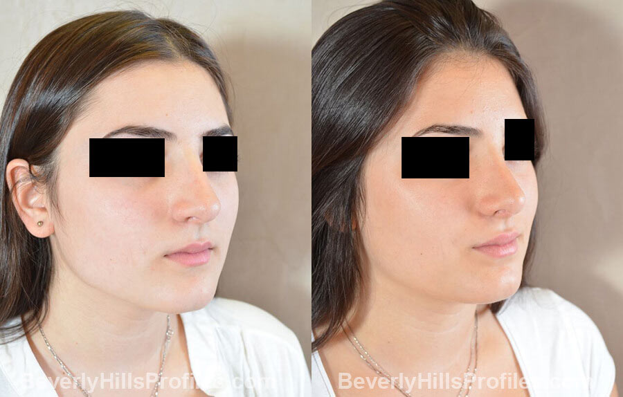 imgs Female patient before and after Nose Surgery oblique view