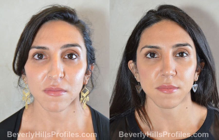 front view - Female patient before and after Nose Surgery