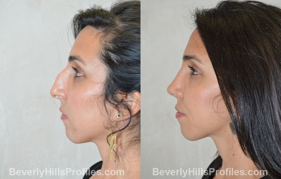 left side view - Female patient before and after Nose Surgery