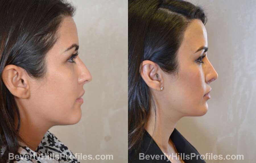 right side view - Female patient before and after Nose Surgery Procedures