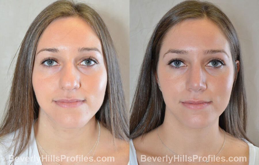 front view Female patient before and after Nose Surgery Procedures