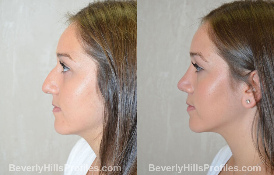 left side view Female patient before and after Nose Surgery Procedures