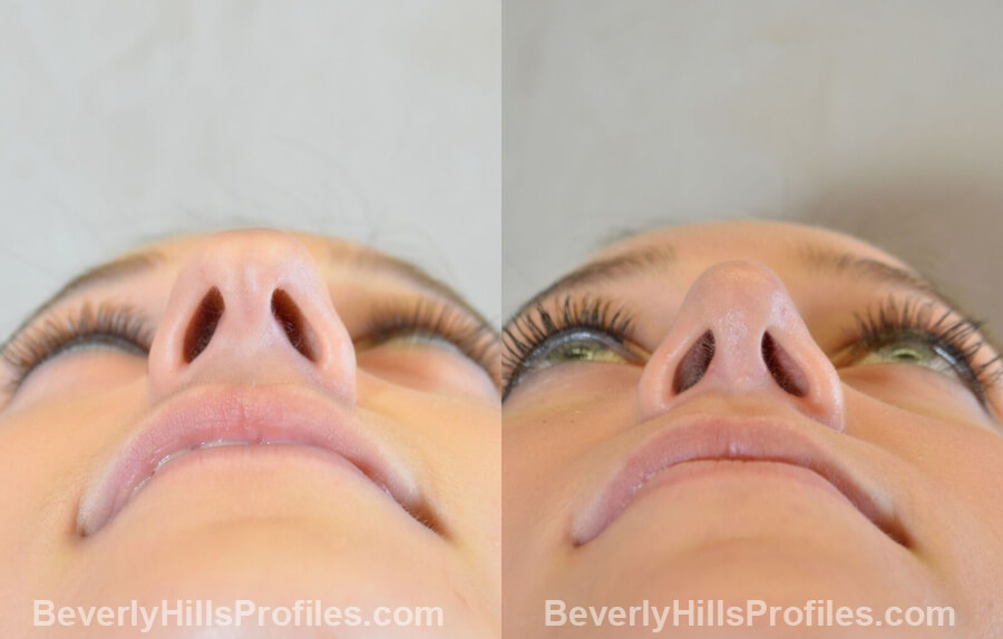 underside view Female patient before and after Nose Surgery Procedures