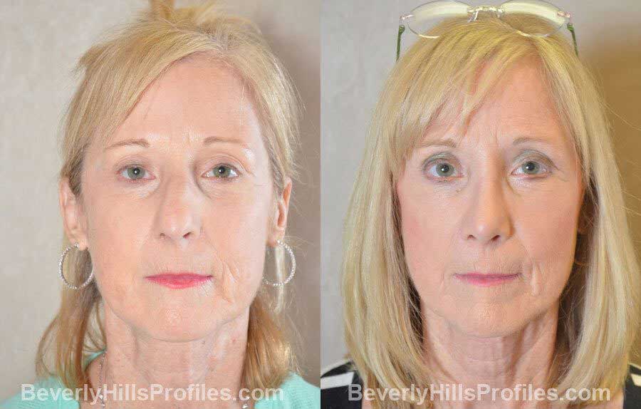 photos Female patient before and after Nose Surgery Procedures - front view