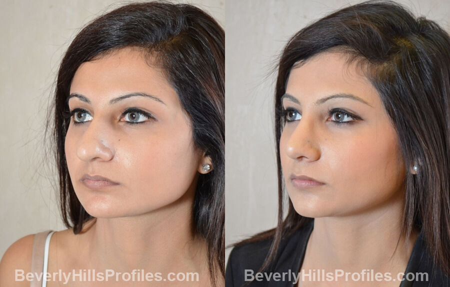 images Female patient before and after Nose Surgery Procedures - left oblique view