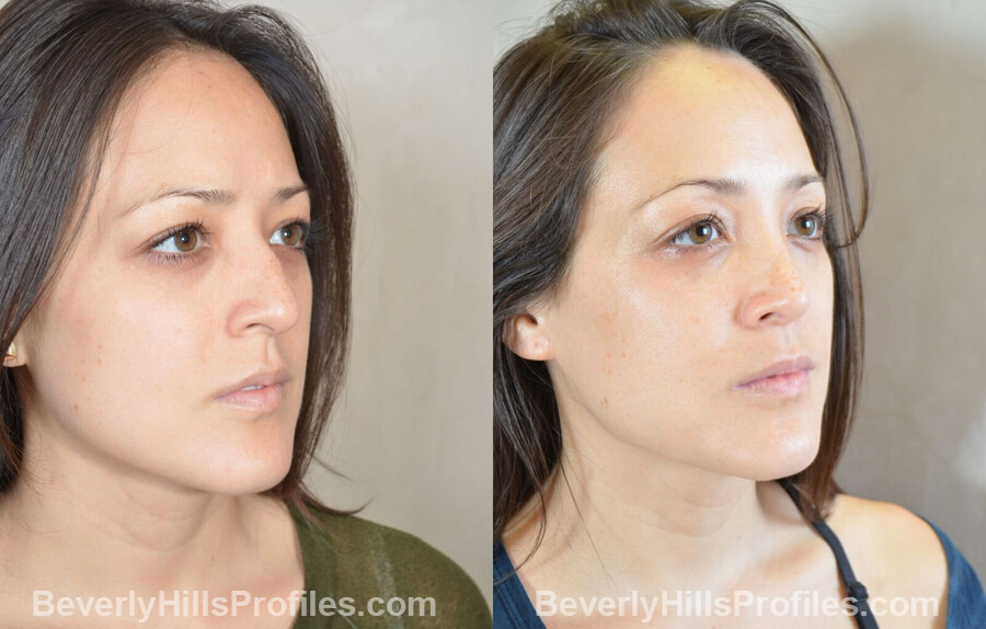 imgs Female patient before and after Nose Surgery Procedures, oblique view