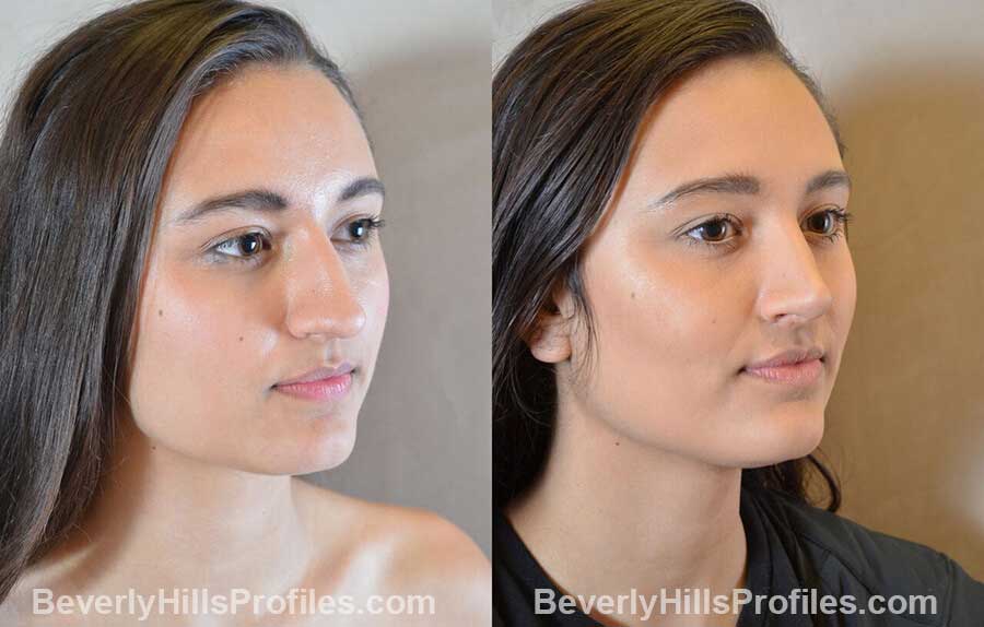pics Female patient before and after Nose Surgery Procedures front view