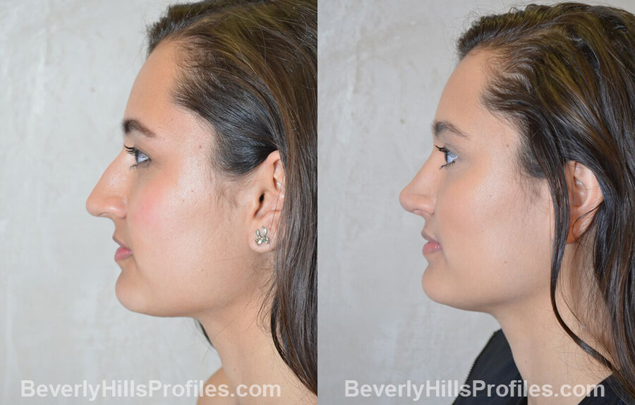 pics Female patient before and after Nose Surgery Procedures left side view