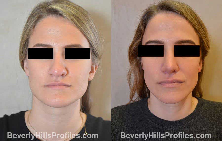 before and after Nose Surgery - front view