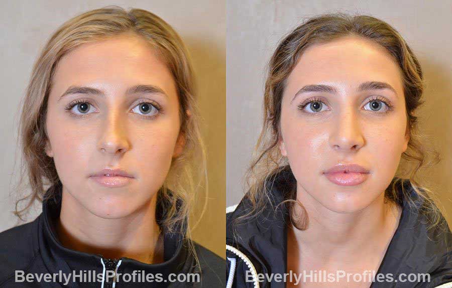 photos before and after Nose Job - front view