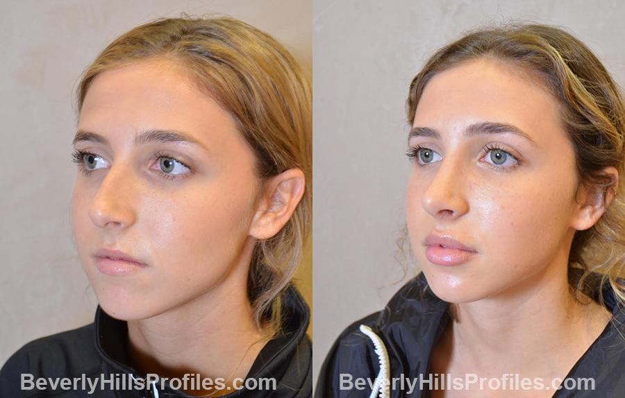 photos before and after Nose Job - oblique view