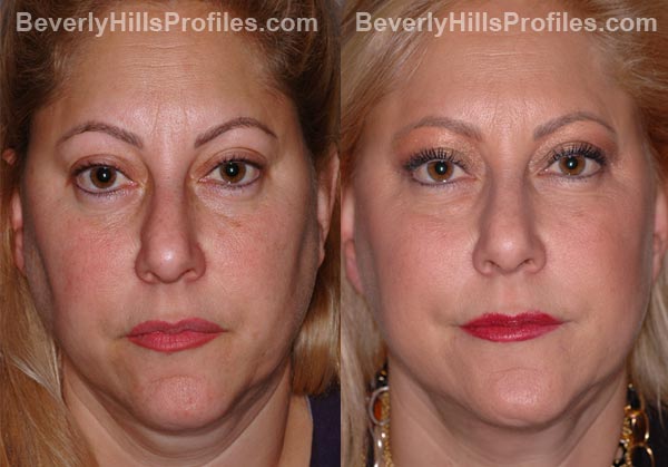 Facelift Before and After Photo Gallery - female, front view, patient 9