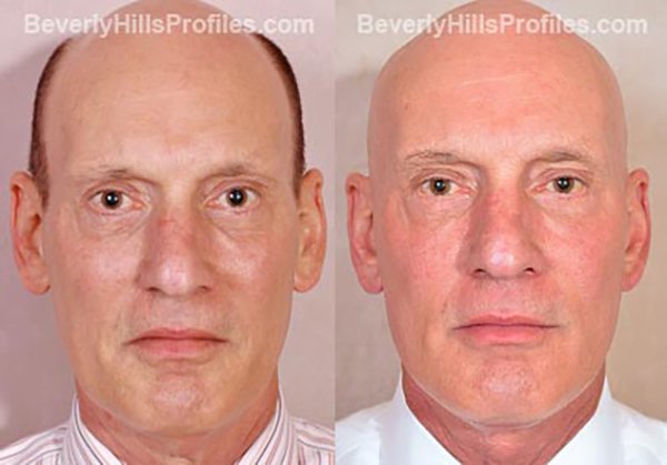 Facelift Before and After Photo Gallery - male, front view, patient 10