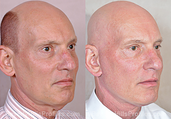 Facelift Before and After Photo - male, oblique view