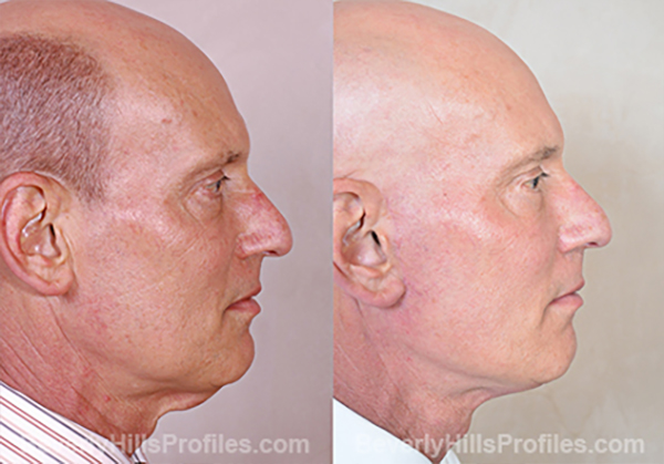 Facelift Before and After Photo - male, side view