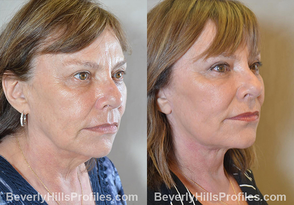 Facelift Before and After Photo - female, right oblique view
