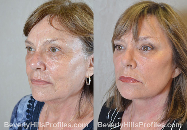 Facelift Before and After Photo - female, oblique view