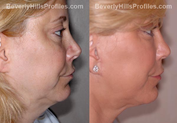 Facelift Before and After Photo Gallery - famale, profile view
