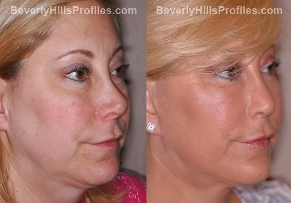 Facelift Before and After Photo Gallery - female, oblique view