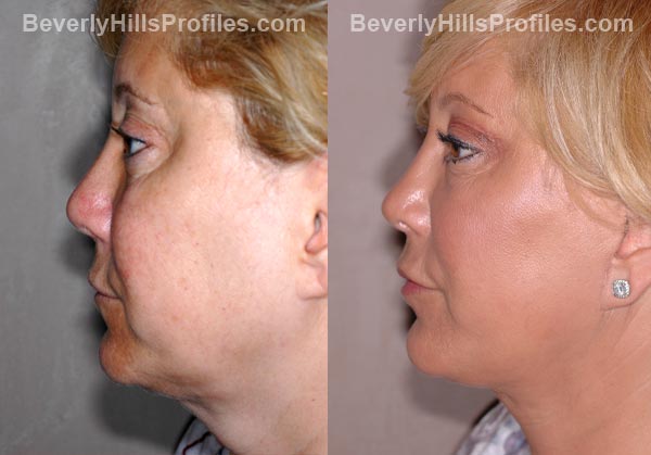 Facelift Before and After Photo Gallery - female, side view