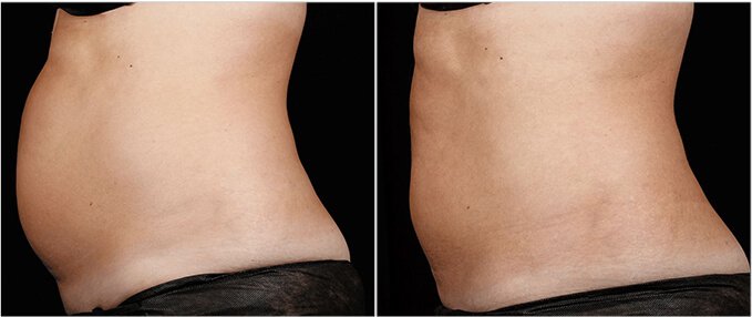 SculpSure Before and After Photos: female, left side view, patient 19