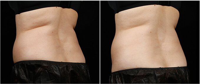 SculpSure Before and After Photos: female, back view, patient 2