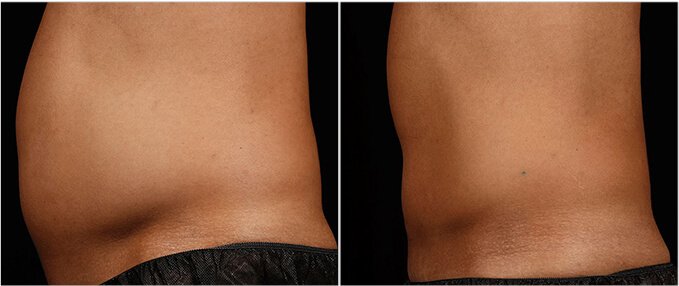 SculpSure Before and After Photos: male, left side view, patient 3