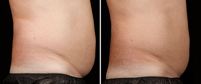 SculpSure Before and After Photos: male, right side view, patient 3