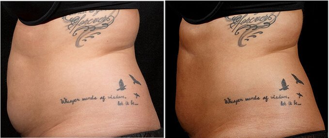 SculpSure Before and After Photos: female, left side view, patient 6