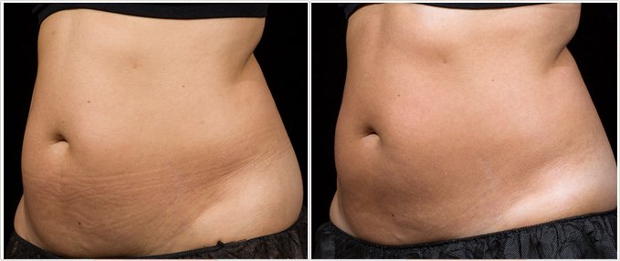 SculpSure Before and After Photos: female, left side oblique view, patient 10