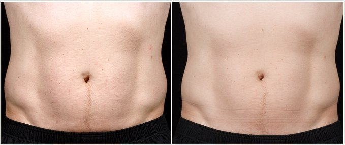 SculpSure Before and After Photos: male, front view, patient 15
