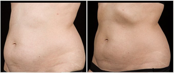 SculpSure Before and After Photos: female, left side oblique view, patient 17
