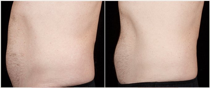 SculpSure Before and After Photos: male, left side view, patient 18